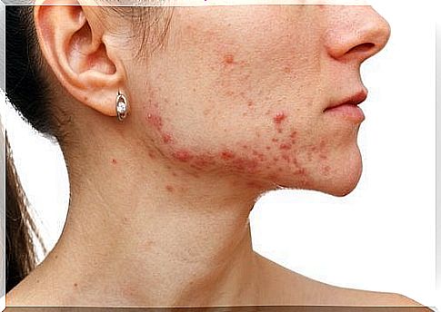 Acne on the face