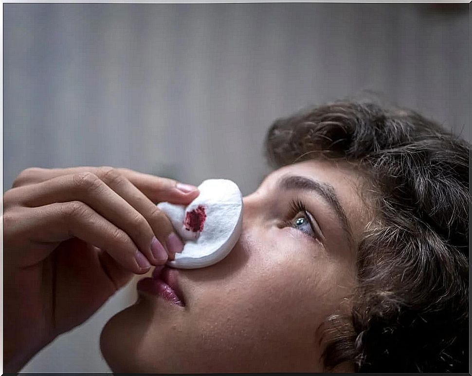 Nose bleeding - remedies to help stop it