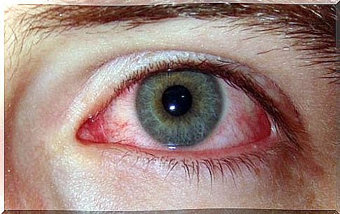 acute eye conjunctivitis