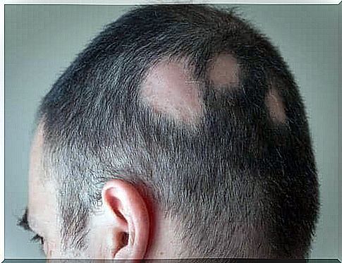 Alopecia areata - causes, symptoms and treatment