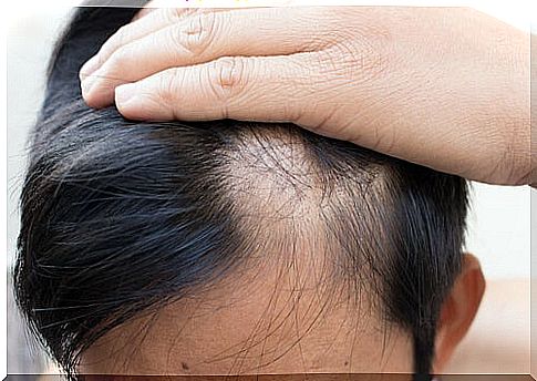 Alopecia areata in a man