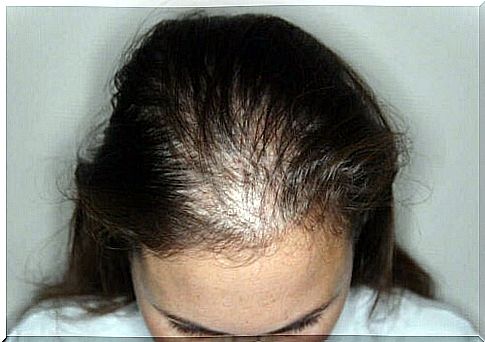 Alopecia in a woman