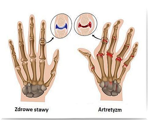 Arthritis - 7 essential rules