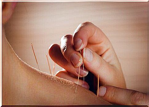 Acupuncture