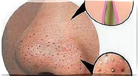 Blackheads and blackheads - how to remove them naturally?