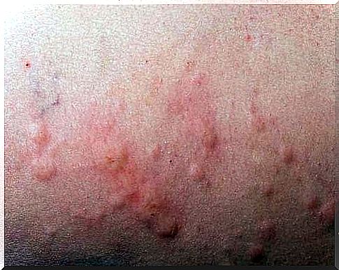 Body rash - how to deal with it?