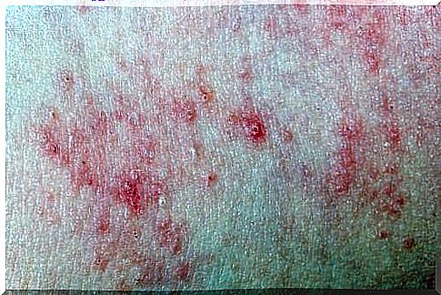 Reddened skin with pustules