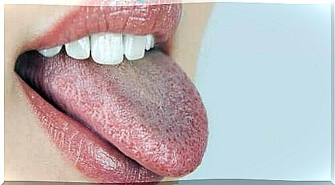 Woman sticking out her tongue - burning sensation in the mouth