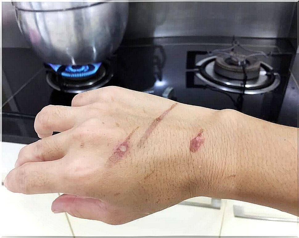 Scalding by boiling water and steam usually occurs when working in the kitchen.