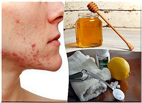 Cystic acne - 6 natural remedies