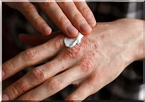 Creaming psoriasis lesions