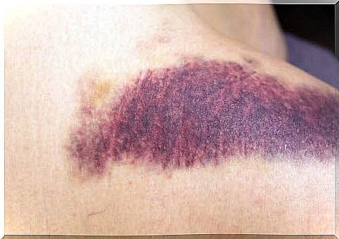 Subcutaneous bruise and vitamin K.