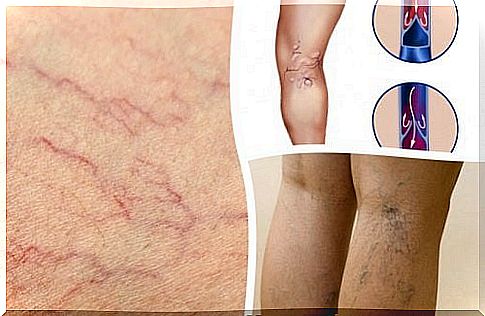 Healthy veins - 5 treatments