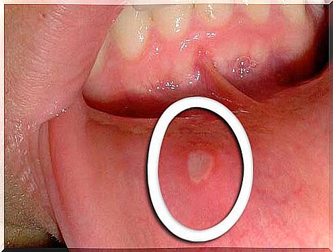 Home remedies for canker sores - solve the problem naturally