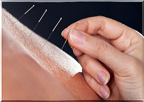 Acupuncture, or needles on the skin