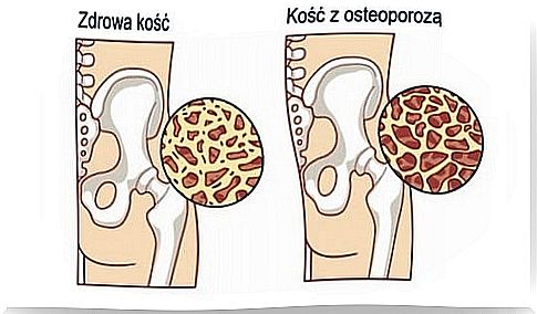 Osteoporosis: 8 foods for healthy bones