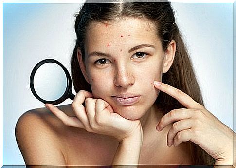 Girl with acne - tea tree oil for skin