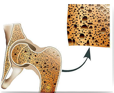 Bones - risk of osteoporosis