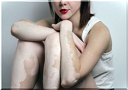 Woman - Vitiligo