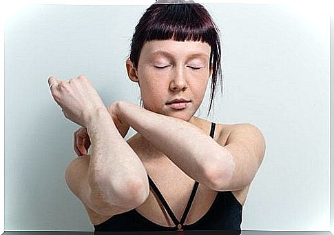 Woman with vitiligo on her elbows