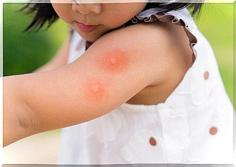 A child bitten by mosquitoes