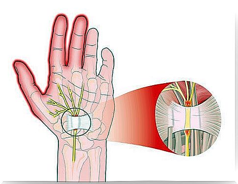 Carpal tunnel syndrome